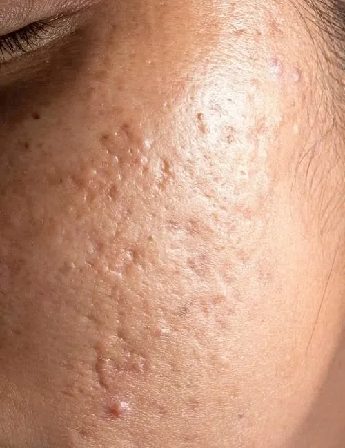 Close-up of skin with acne scars